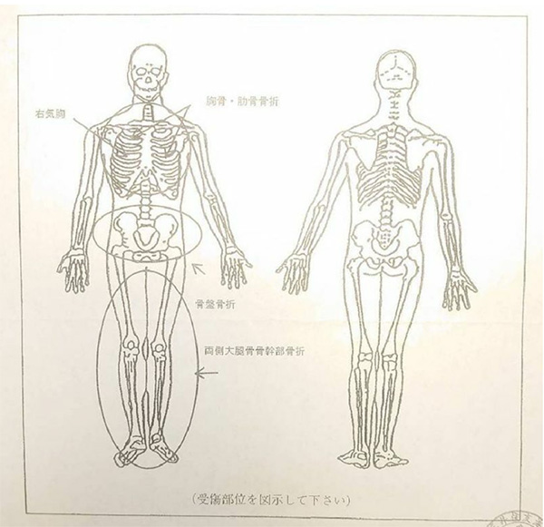 死亡診断書に記載された受傷部位。CT検査の結果、小柳さんは首から下の主要な骨がほとんど骨折していたことがわかった（遺族提供）
