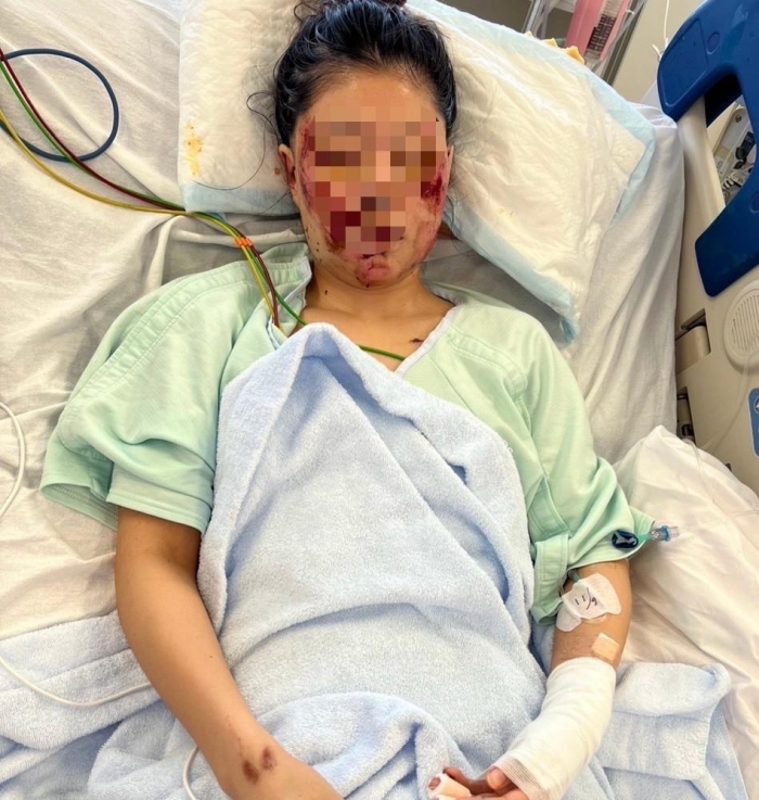 事故から約1週間後、陰圧創傷治療を受ける琴さん（家族提供）