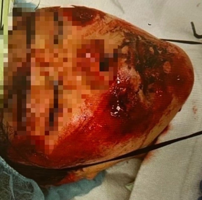 ひき逃げ事故の被害者・高橋琴さん(仮名)の受傷直後顔面写真。直視するのがつらい写真ではあるが、事故の実態を如実に伝えてくれている