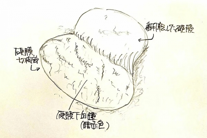 シンポジウムで脳神経外科医が示した開頭時のイメージイラスト。これでは硬膜下血腫の状況を伝えることができない（高橋弁護士提供）