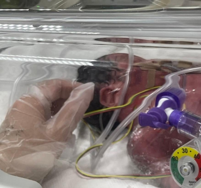 事故当日、緊急の帝王切開によって取り出され、NICU（新生児集中治療室）を備えた別の病院へ救急搬送される際の日七未ちゃん。母親の沙也加さんは、2日後、我が子を抱くことも叶わず亡くなった（家族提供）