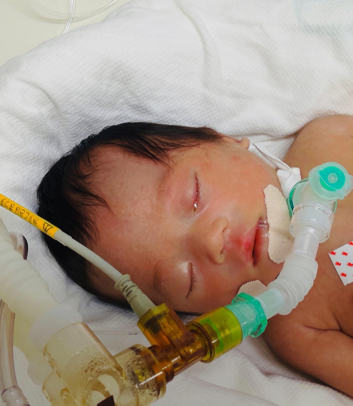 気管切開を受けたころの日七未ちゃん（家族提供）