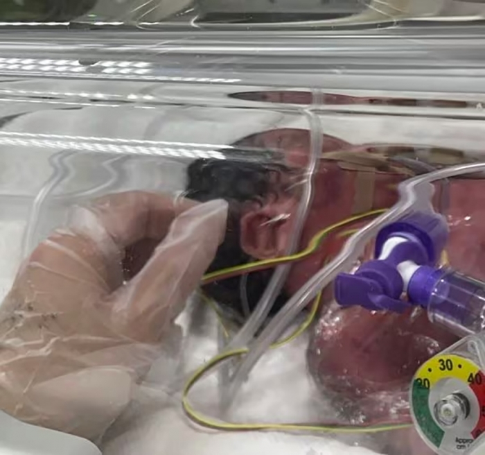 生まれた直後、NICUのある病院へ移送される直前の日七未ちゃん（家族提供）